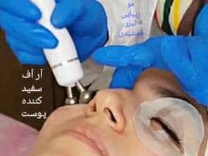 انجام آر اف برای سفید کننده پوست