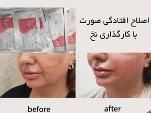 اصلاح افتادگی صورت با نخ