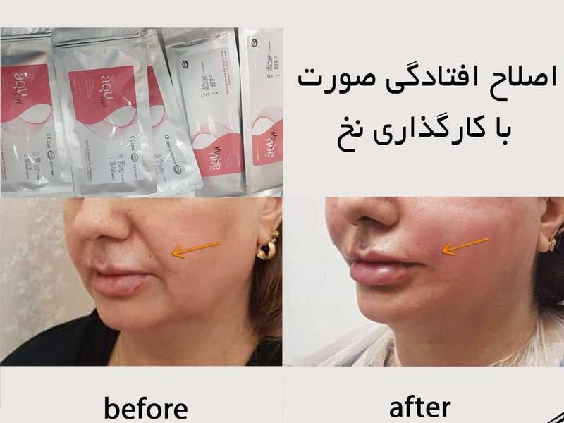 اصلاح افتادگی صورت با نخ
