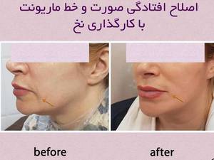 اصلاح خط ماریونت با نخ