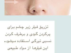 فیلر زیر چشم
