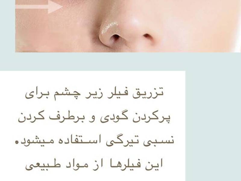 فیلر زیر چشم