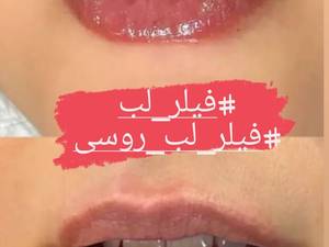 تزریق ژل لب ویافیلرلب