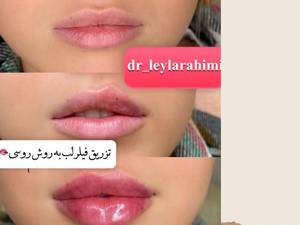 تزریق ژل لب ویافیلرلب