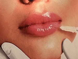 تزریق انواع ژل لب با ماندگاری بالا