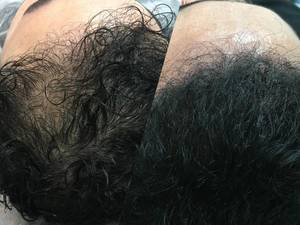 میکرواسکالپ کف سر