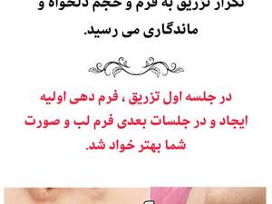 تزریق فیلر
