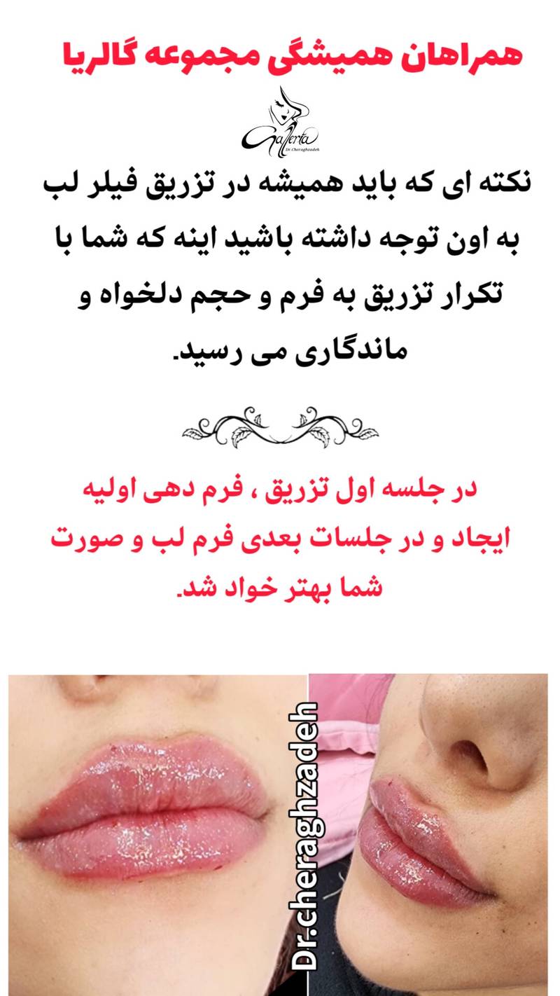تزریق فیلر