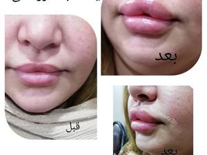 لیفت لب عروسکی بوشهر