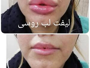 لیفت لب روسی بوشهر