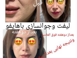 هایفو جوانساز قوی مطب زیبایی بوشهر