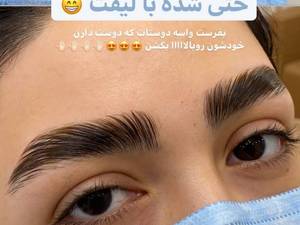 لیفت ابرو 