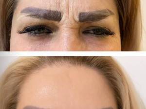 فواید بوتاکس پیشانی