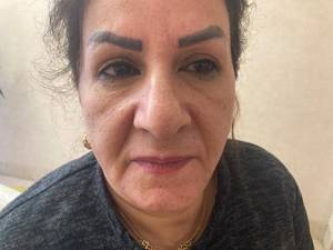 لیفت صورت با نخ