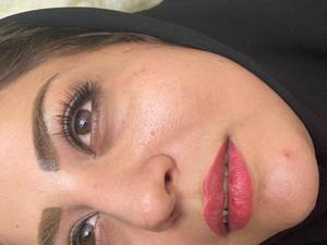 تزریق ژل لب با کلینیک ری نیو