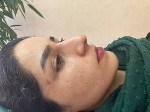 اصلاح فرم بینی