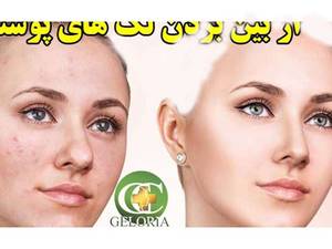 از بین بردن لک های پوستی