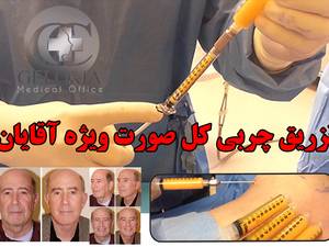 تزریق چربی