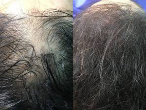 میکرواسکالپ کف سر