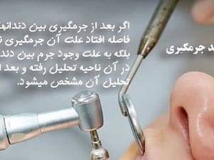 دندان ها بعد از جرمگیری