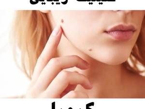 برداشتن خال و زگیل 