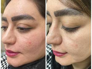 رفع افتادگی گونه با نخ