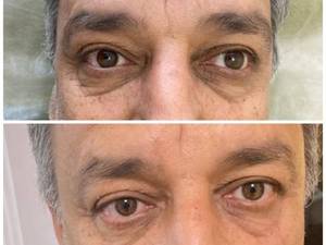 فیلر زیر چشم برای آقایون 