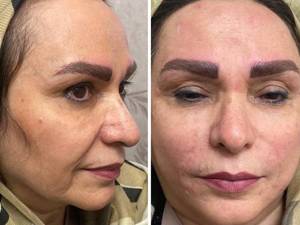 رفع خط خنده با کلینیک ری نیو