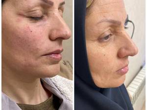 تزریق فیلر چشم و جوانسازی صورت