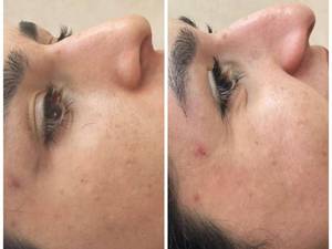 اصلاح فرم بینی بدون جراحی