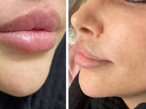 تزریق ژل لب با بهترین ژل