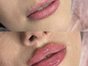 هزینه تزریق فیلر لب روسی 
