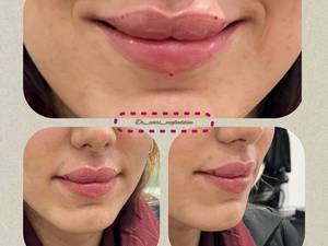 تزریق فیلر لب روسی