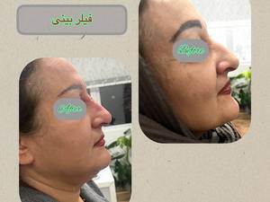 فیلر بینی