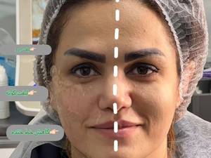 هایفوتراپی صورت