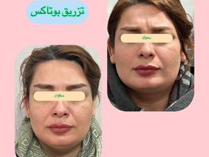 بوتاکس صورت