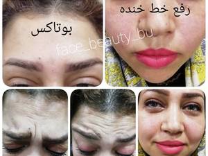 هزینه از بین بردن خط خنده