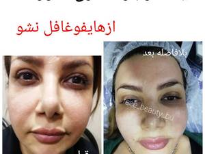 هایفوتراپی در بوشهر