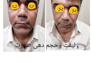 قیمت لیفت صورت