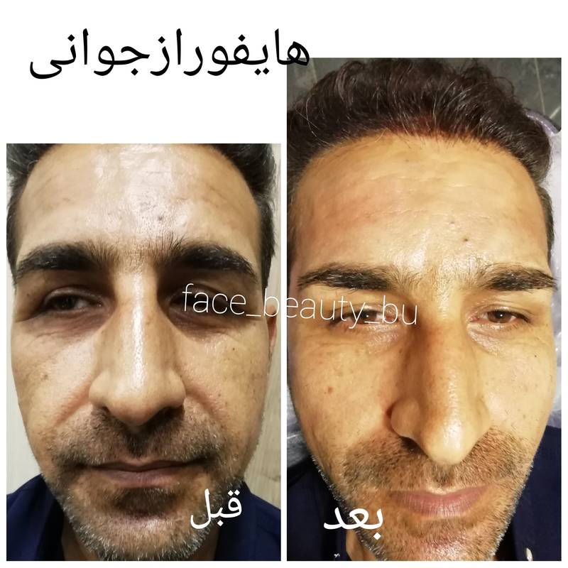 هایفوتراپی بوشهر