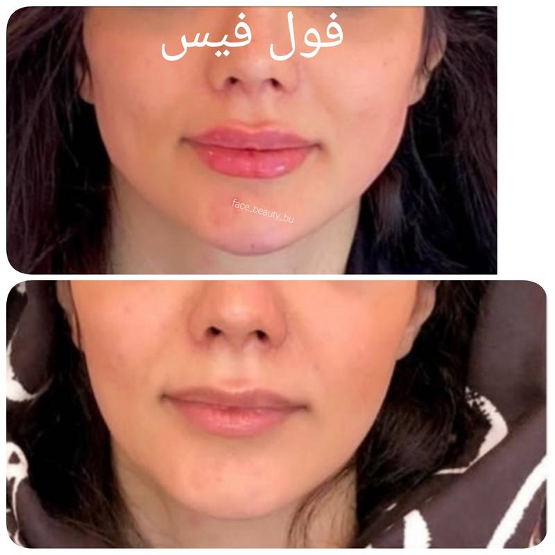 قیمت بوتاکس فول فیس