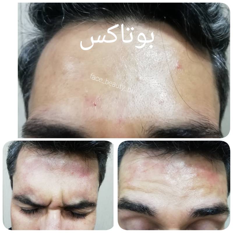 قیمت تزریق بوتاکس