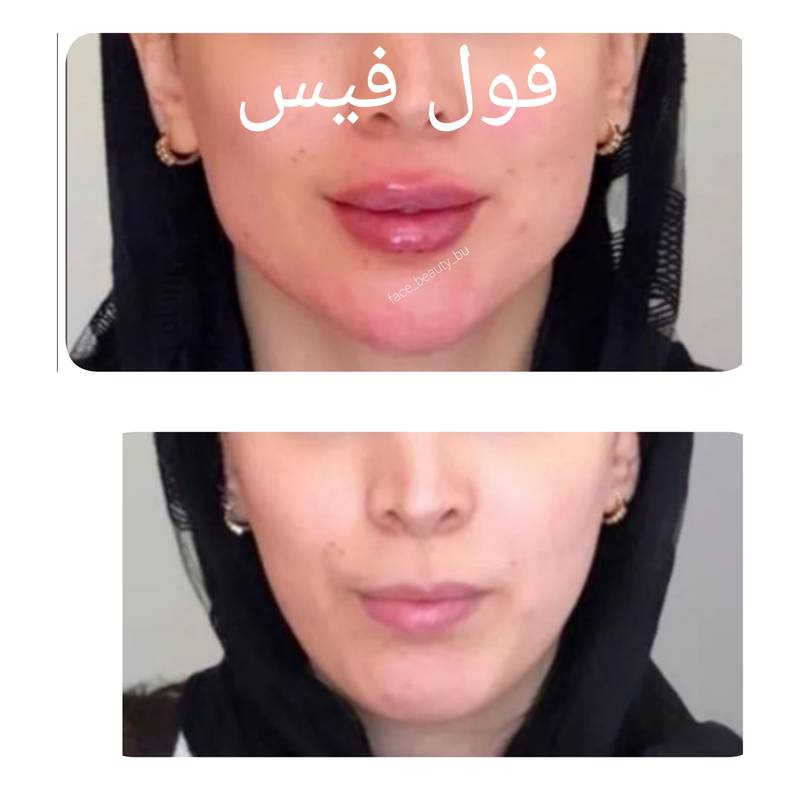 هزینه زاویه سازی صورت در بوشهر