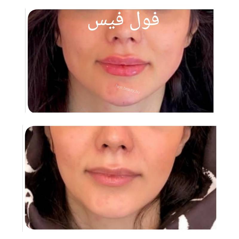 کانتورینگ زاویه سازی صورت