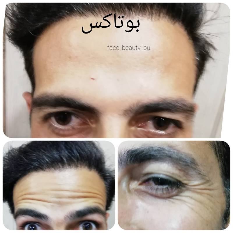 هزینه تزریق بوتاکس