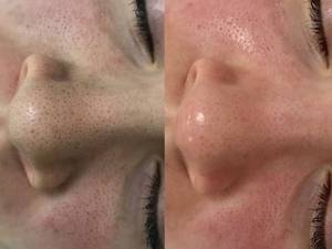 فشیال و پاکسازی صورت