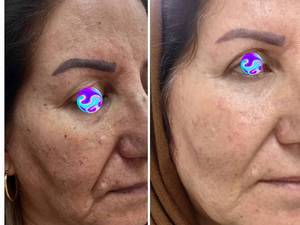 رفع لک صورت با جدیدترین دستگاههای لیزر