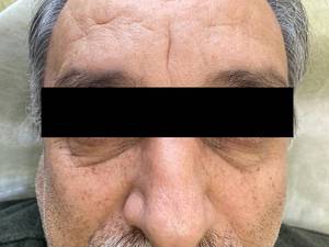 تزریق فیلر پای چشم برای سنین بالا