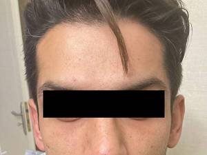 تزریق فیلر زیر چشم برای جوانان