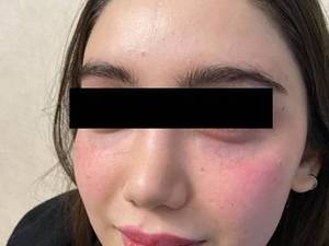 قیمت تزریق فیلر زیر چشم برای بانوان در یزد